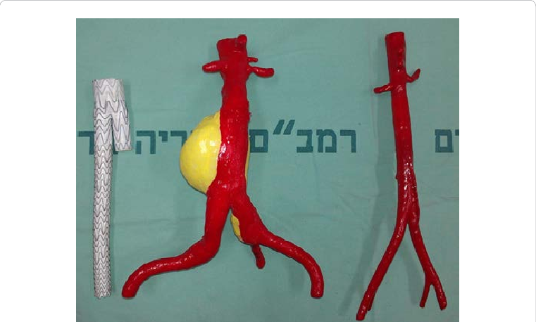 3d Models In Evar Planning - Endovascular Aneurysm Repair (761x458), Png Download