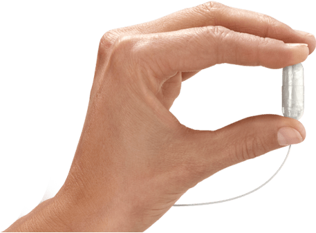 Obalon-capsule - Gastric Balloon (550x400), Png Download