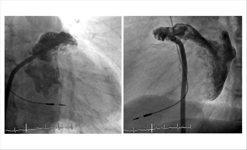 Magens Angiográficas Do Apêndice Atrial Esquerdo, Em - Left Atrial Appendage (850x516), Png Download
