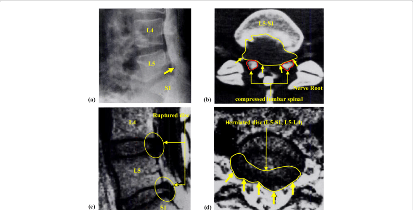 Standard Profile Of The Lumbar Sacral Spine Radiograph - Vertebral Column (850x433), Png Download