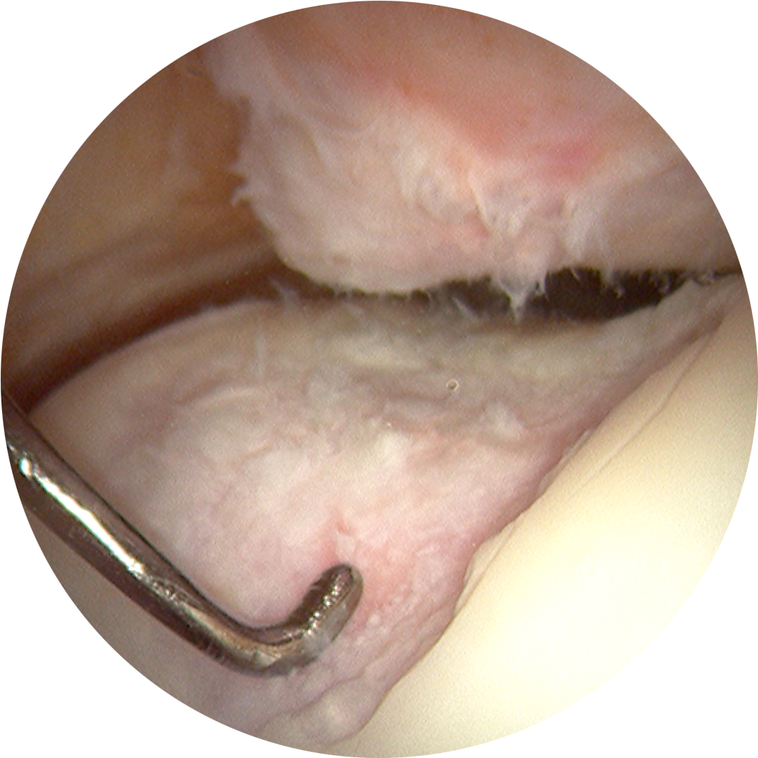 Knee Injuryand Osteoarthritis Outcome Survey Results - Arthroscopic View Of Knee Osteoarthritis (1920x1080), Png Download