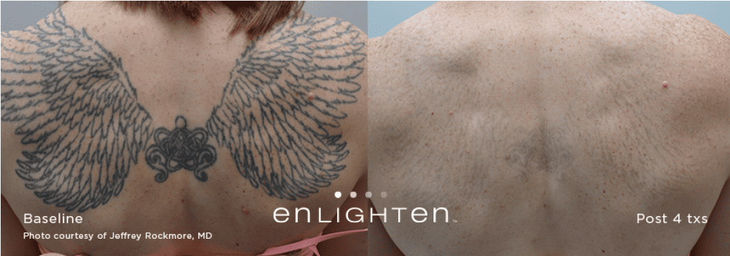Tattoo Removal* - Tattoo Removal (1060x440), Png Download