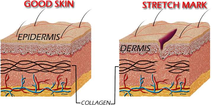 Alteration Of The Dermis, Gives Rise To Stretch Marks - Stretch Marks Cause (750x373), Png Download