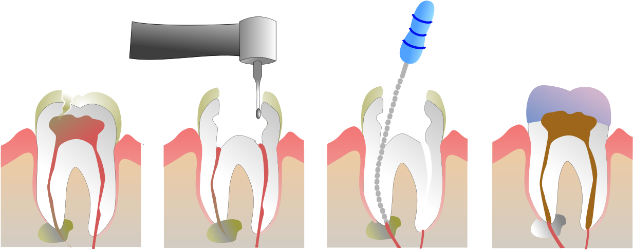Chico Dentist Root Canal - Root Canal Therapy (1000x400), Png Download