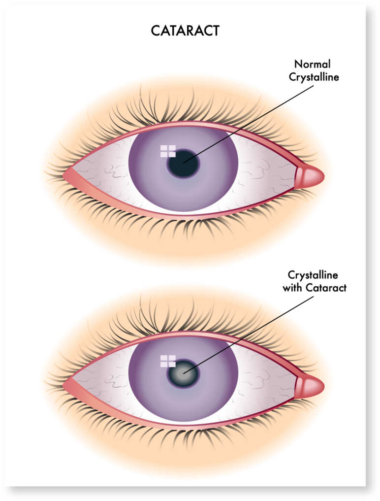 Cataract Symptoms - Redness In Conjunctiva (780x1024), Png Download