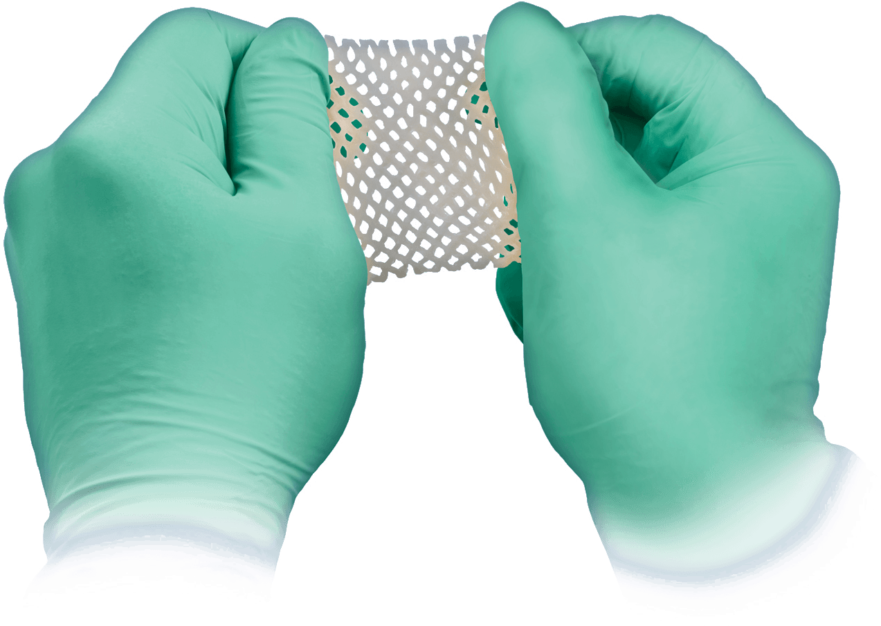 A Pre Shaped Bone Wedge - Hand (1500x1125), Png Download