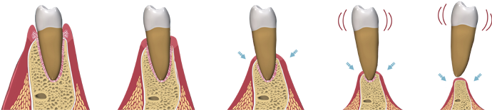 Implantes Dentales Cuando Hay Poco Hueso - Dental Bone Loss (700x180), Png Download