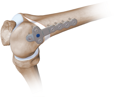 Femoral Opening Wedge Osteotomy Plates 0 Large - Arthrex Distal Femoral Osteotomy (400x370), Png Download