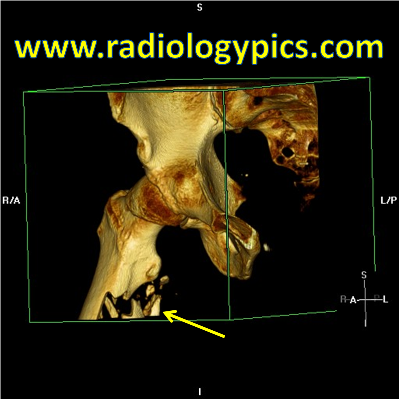 Subtrochanteric Femur Fracture - Millenium Development Goal 7 (1052x802), Png Download