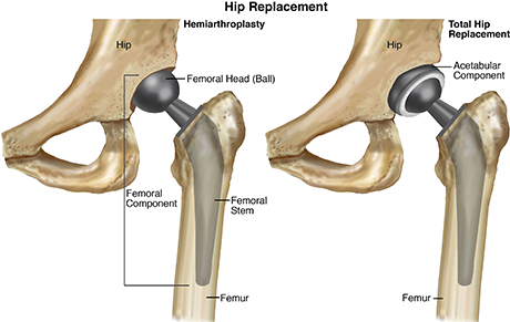 Hemiarthroplasty Vs Total Hip Replacement (500x300), Png Download