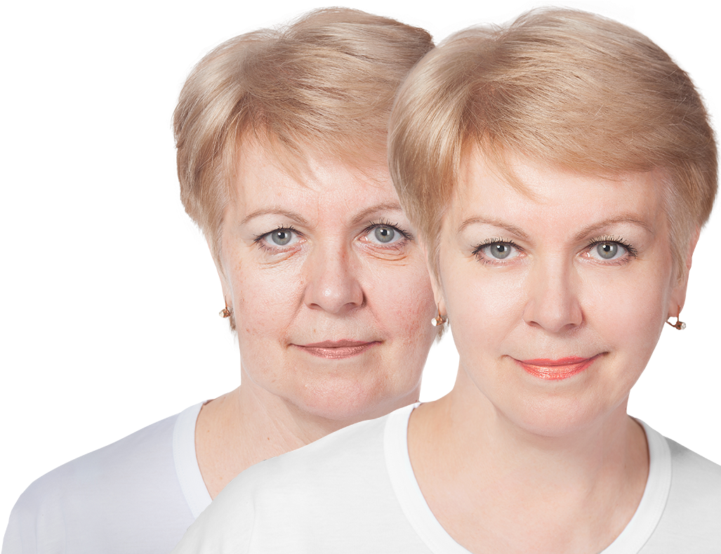 Before And After Image Of Woman's Face After Plastic - Plastic Surgery (1038x814), Png Download