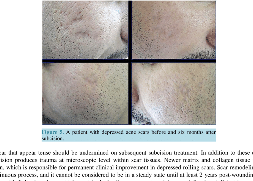 A Patient With Rolling & Icepick Acne Scars Before - Acne (850x623), Png Download