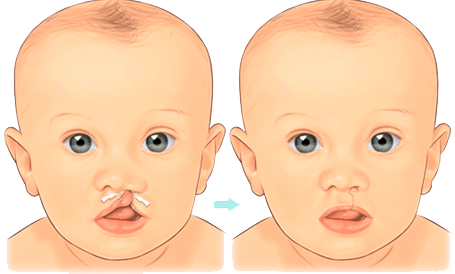 Association - Cleft Lip And Palate Before (455x274), Png Download