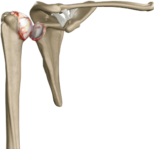 Shoulder Joint Arthritis - Adhesive Capsul Itis (371x360), Png Download