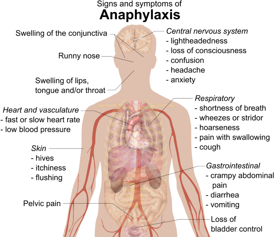 There Are Many Possible Signs Of Anaphylaxis - Anaphylactic Shock (713x600), Png Download