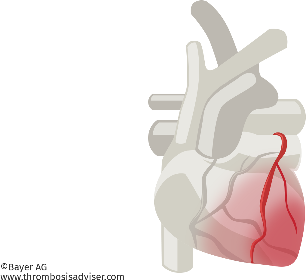Cardiac Muscle Damage In Acs - Arterial Blood Gas Test (1580x972), Png Download
