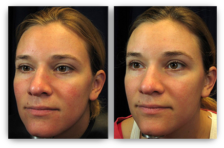 Safely Eliminating Blue Vessels Near The Eye - Laser Treatment For Redness (437x289), Png Download