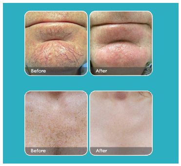 South Florida Vein Aesthetics - Laser (370x440), Png Download
