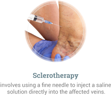 Sclerotherapy - Earth (500x400), Png Download