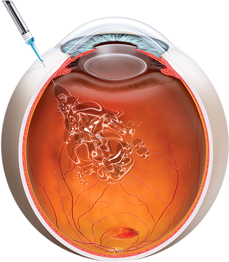 Anti-vegf Injection - Intravitreal Gas Injection (600x635), Png Download
