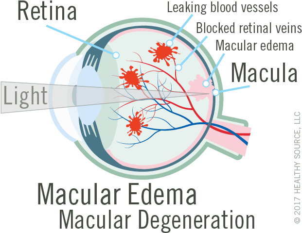 Bleeding, Leaking, And Scarring From The Damaged Blood - Blood Supply To Macular (640x511), Png Download
