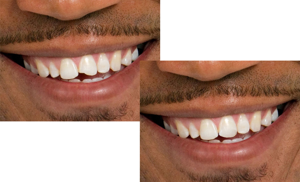 A Before And After Photo Of Dental Bonding - Dental Bonding (1000x607), Png Download