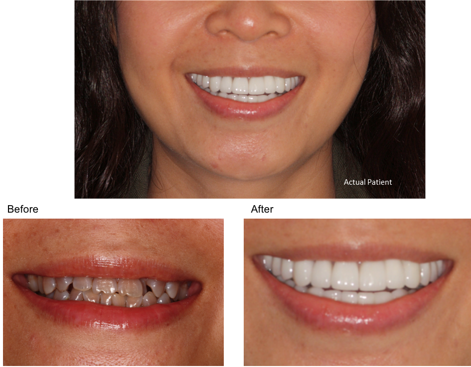 Tetracycline Solutions - Tetracycline Teeth Stain (945x737), Png Download