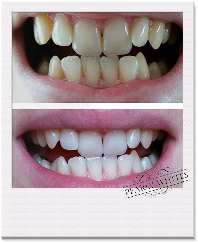 Teeth Whitening Before And After Photos From A Pearly - Home Teeth Whitening (517x517), Png Download