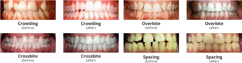 Invisalign - Crossbite Treated With Invisalign (801x220), Png Download