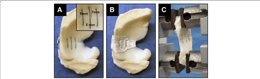 Suture Repair Of Meniscal Tears And Mechanical Testing - Tear Of Meniscus (850x261), Png Download
