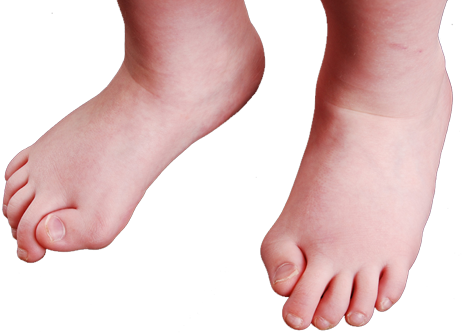 Toes - 性 骨 化 性 線維 (462x333), Png Download