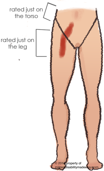 Scar Example 4 - Kidney Transplant Scar On Leg (400x648), Png Download