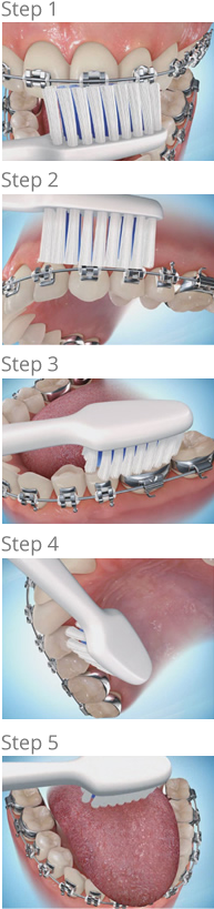 Brushing Steps - Petaluma Orthodontics - Brush Your Teeth When You Have Braces (200x820), Png Download