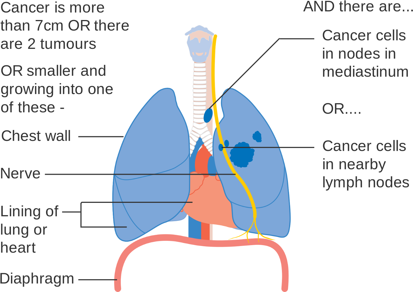 Common Lung Diseases And Their Causes - Side Determination Of Lungs (1600x1171), Png Download
