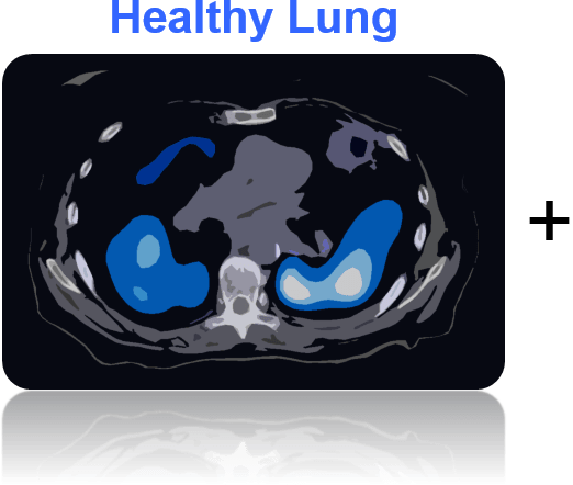 Healthy-lung - Cancer (522x442), Png Download