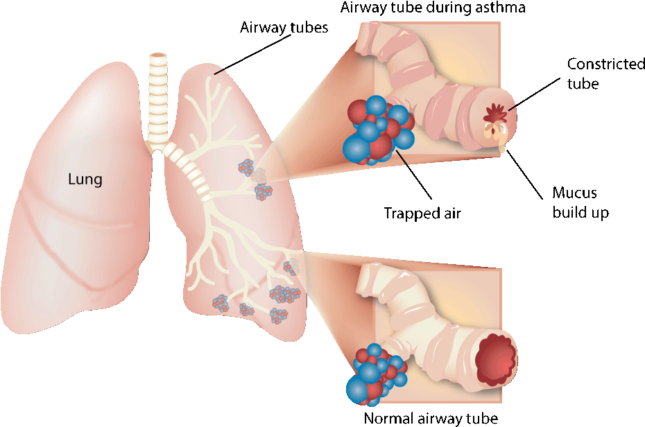Lungs During Asthma Attack - People With Asthma And Smoking (976x621), Png Download
