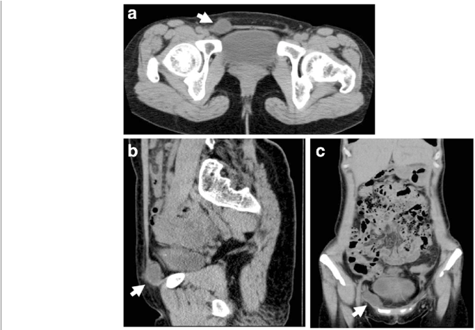 Computed Tomography Scans Showing A Round Cystic Lesion - Computed Tomography (850x473), Png Download