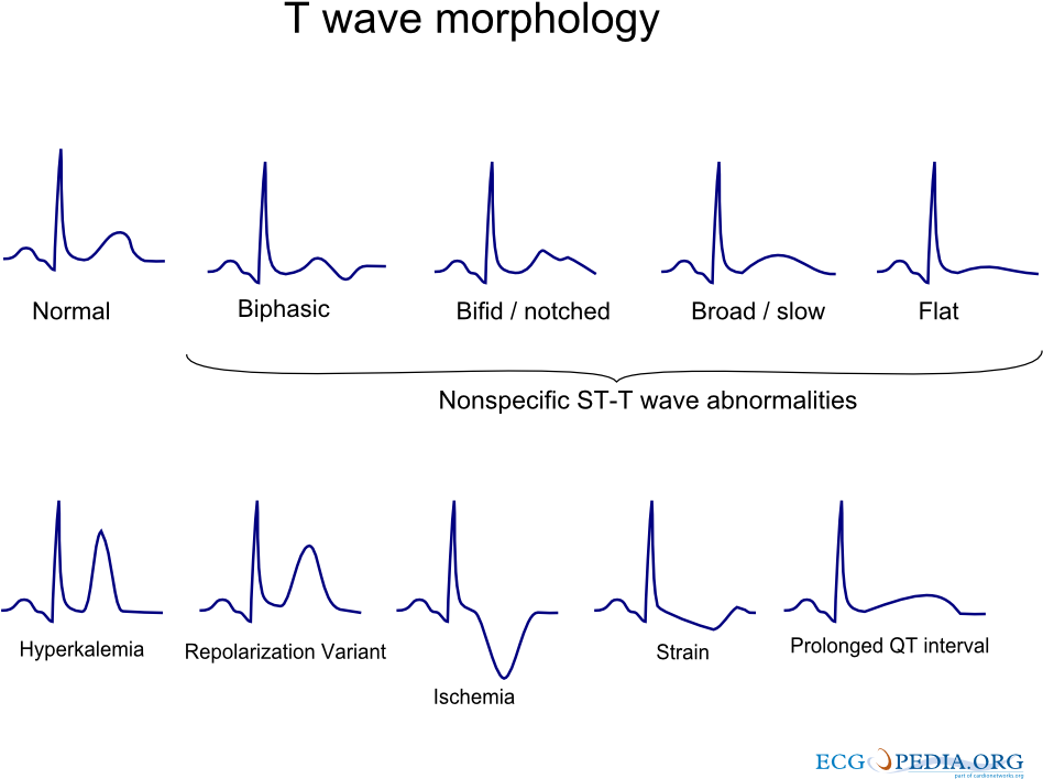 T Wave Morphology (1000x750), Png Download