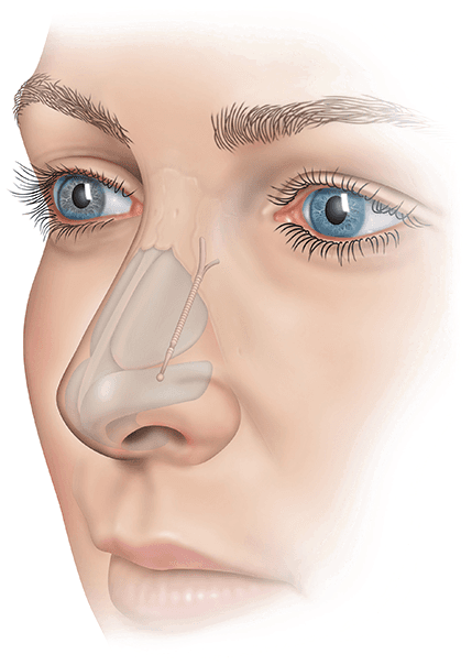 Patients Who Have Experienced Nasal Obstruction From - Nose Implant (487x643), Png Download