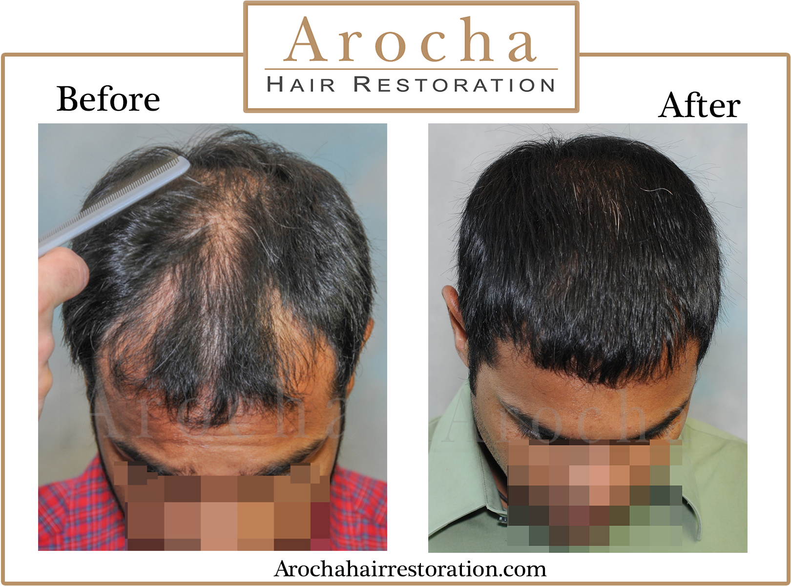 Fut Hair Transplant Texas - Hair Transplantation (1790x1260), Png Download