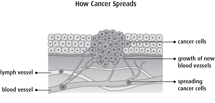 Diagram Of How Cancer Spreads - Comment Le Cancer Se Developpe (696x334), Png Download