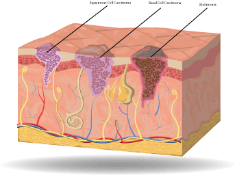 Large Skin Cancer Cell - Box (400x400), Png Download