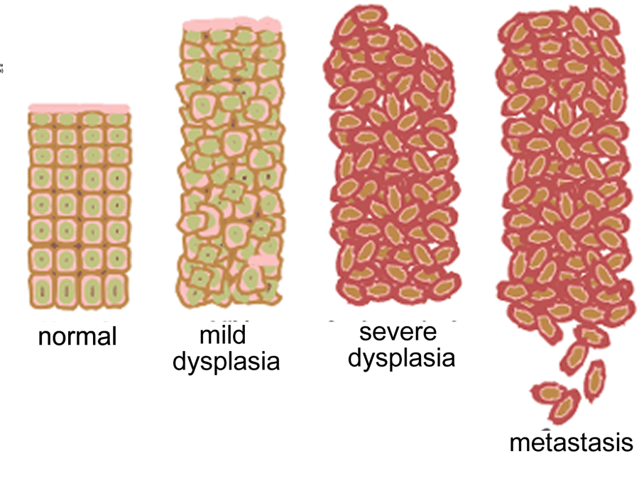 Progressive Increases In Cell Division And Abnormal - Cancer Cell (907x688), Png Download