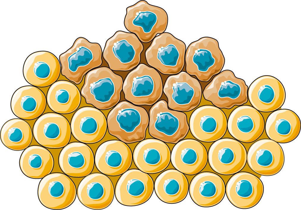 Carcinoma - Cancer Cell Clipart (1012x706), Png Download