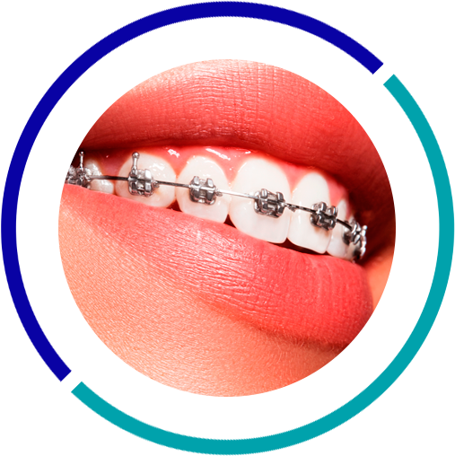 Download Orthodontics Dental Braces Price In Qatar Full Size PNG