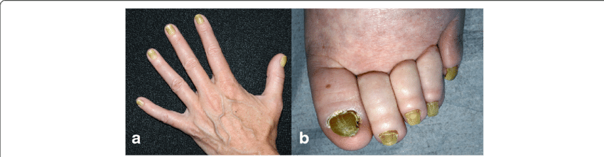 Yellowing Of All 10 Finger And (b) Toe Nails - Yellow Nail Syndrome (850x222), Png Download