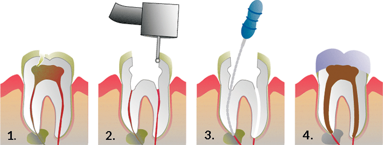 Root Canal Therapy Is Required When A Tooth Is Infected - One Visit Root Canal (745x282), Png Download