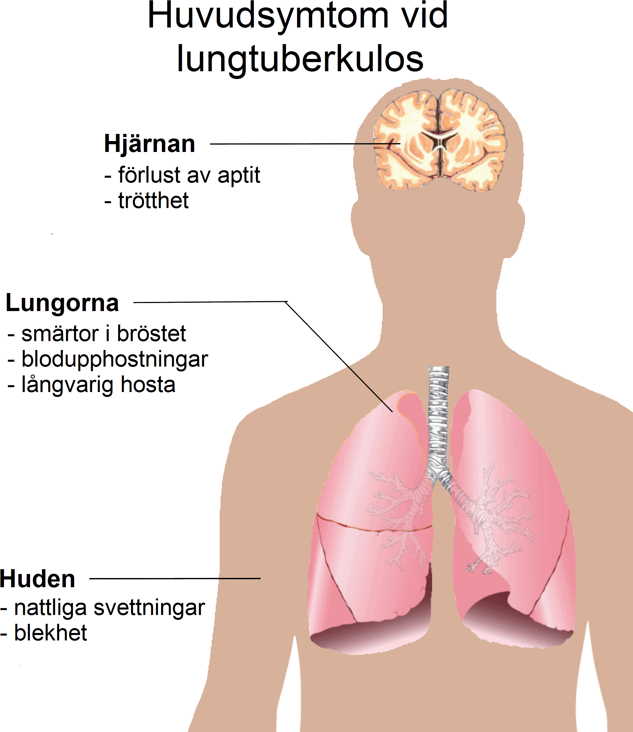 Pulmonary Tuberculosis Symptoms Swedish - Symptoms Of Tuberculosis (2244x2569), Png Download