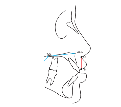 -measure Of Upper Lip Height - Anterior Nasal Spine (479x424), Png Download