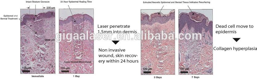 The Beautyscan™ Transmits The 1550nm Laser Energy In - Lace (840x278), Png Download
